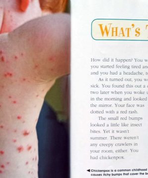 Alternative view of Chickenpox (head-to-toe)