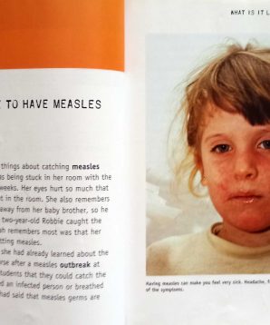 Alternative view of Measles and mumps